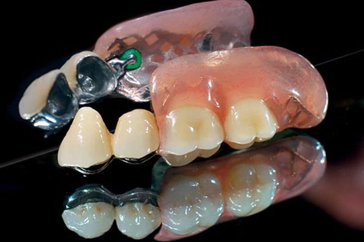 金属基托可摘活动义齿图