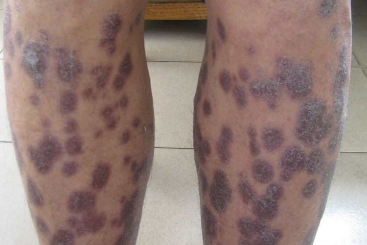 梅毒小腿结节图