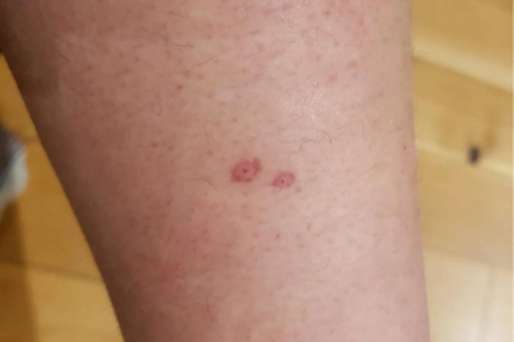 水蛭咬伤小腿伤口图