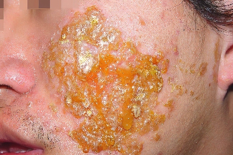 急性湿疹渗液图