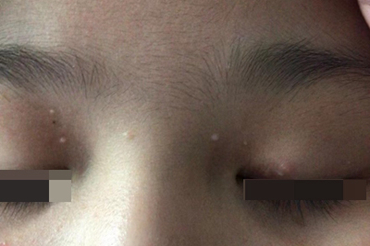 传染性软疣小疙瘩图