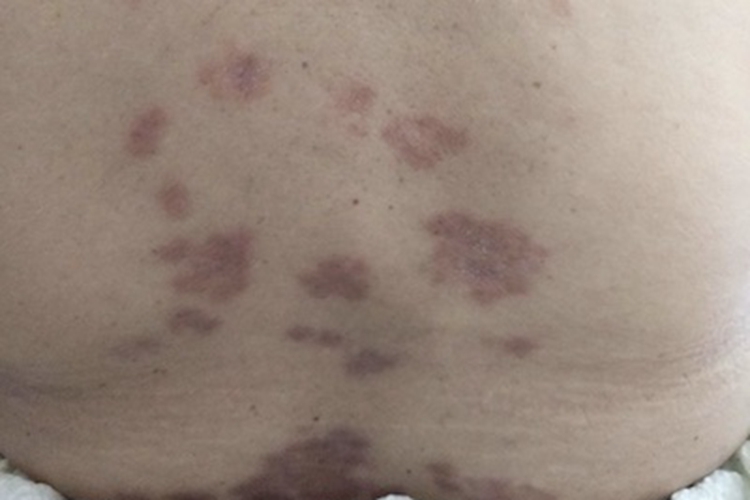 结节性液化性脂膜炎斑图 结节性液化性脂膜炎斑图