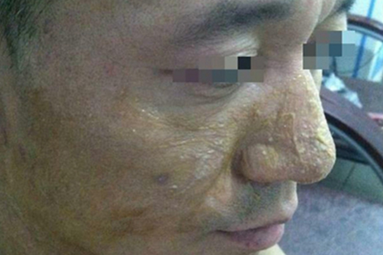 光接触性皮炎面部脱皮图