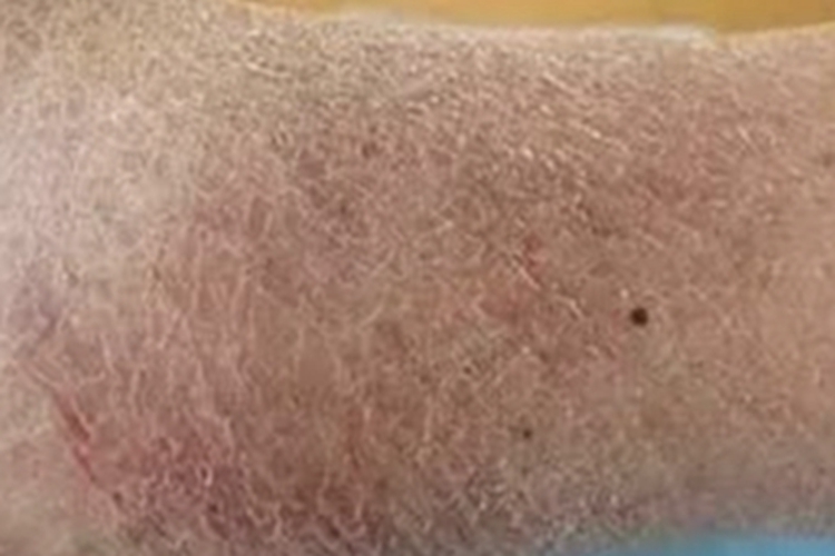 干性湿疹小腿干燥起皮图