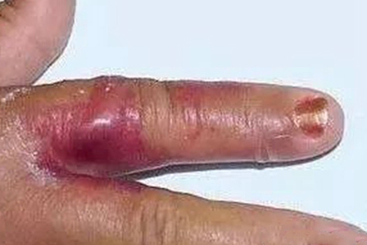 局限型类丹毒手指水肿性斑块图