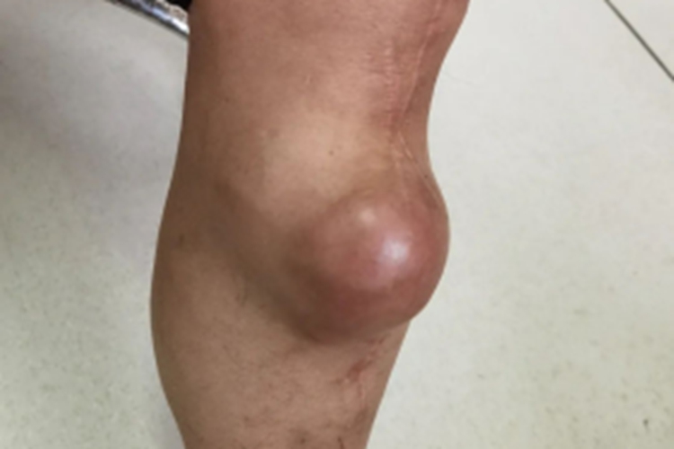 胫骨骨巨细胞瘤图