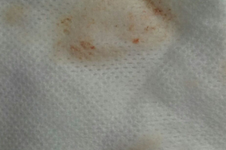 婴儿咽下综合征吐奶图