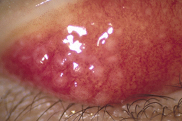 滤泡性结膜炎小疙瘩图 滤泡性结膜炎小疙瘩图