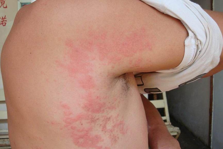 螨虫过敏躯干丘疱疹图 螨虫过敏躯干丘疱疹图