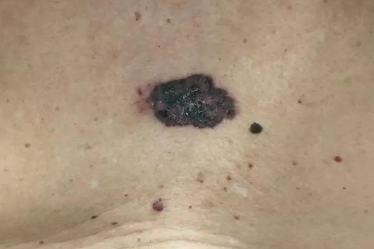 痣细胞痣图 痣细胞痣图