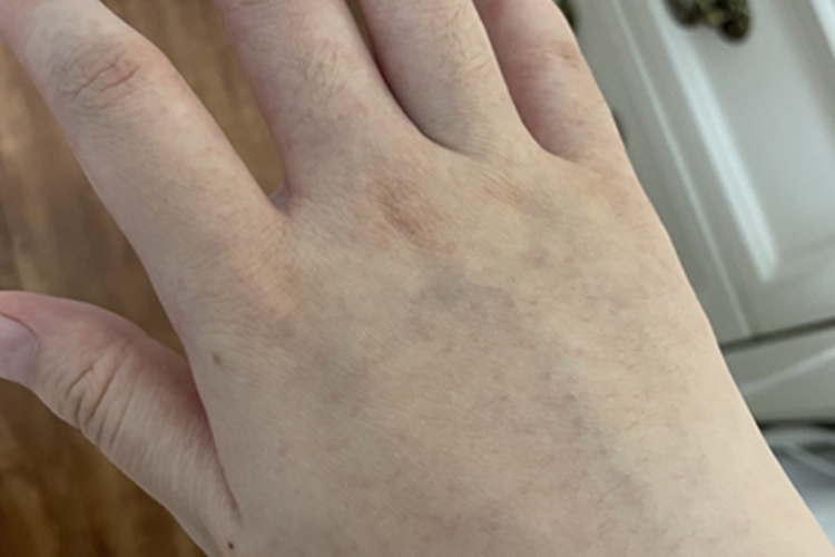 毛发角化病手背有丘疹图