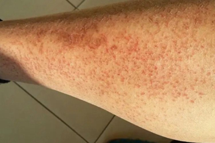 亚急性湿疹小腿小疙瘩图