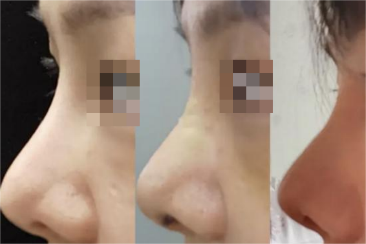 鼻假体取出前后照片对比图