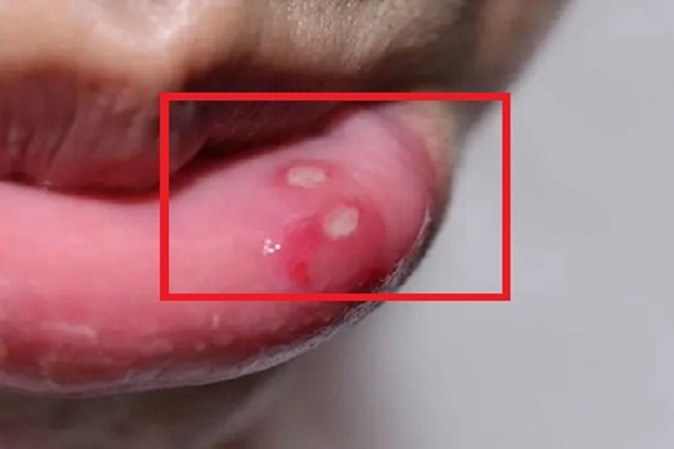 二期口腔梅毒唇内侧白斑图
