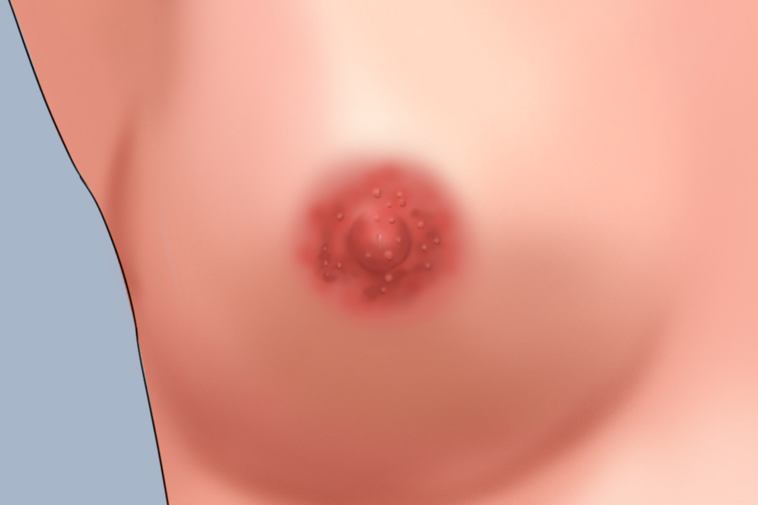 乳房湿疹乳头手绘图