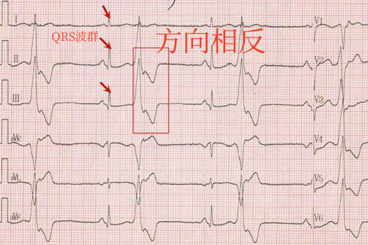 室性期前收缩心电图 室性期前收缩心电图