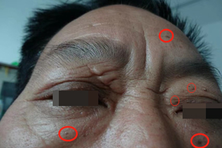 脂溢性角化病面部小疙瘩图