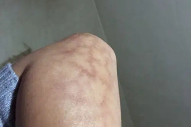 火激红斑胳膊症状图