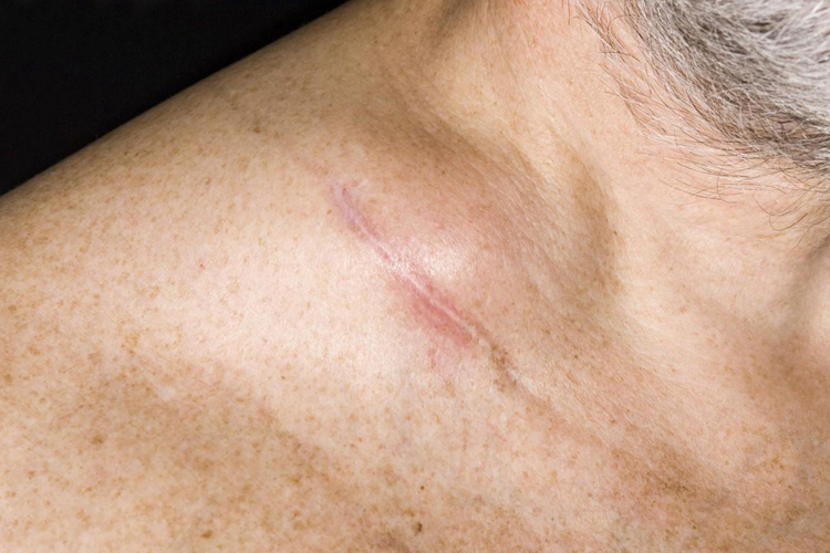 淋巴结结核图 淋巴结结核图