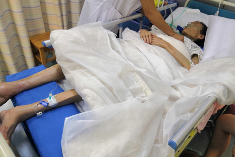 恶性黑色素瘤晚期进行性消瘦图