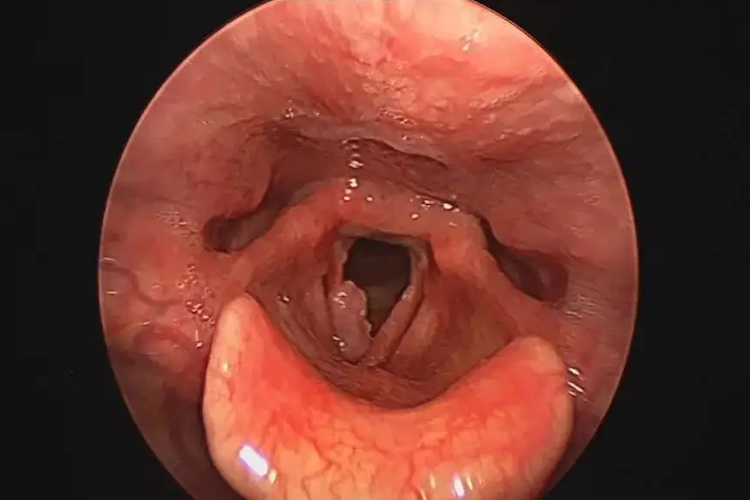 喉癌根据发生的部位,可分为声门上癌,声门癌,声门下癌及贯声门癌,其
