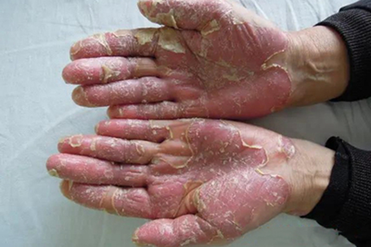 脓疱性肢端皮炎手掌脱皮图 脓疱性肢端皮炎手掌脱皮图