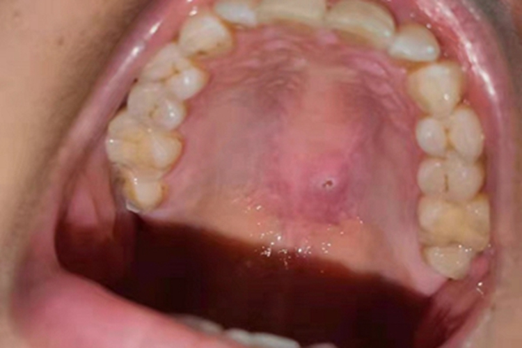 口腔溃疡上腭有一点破溃图