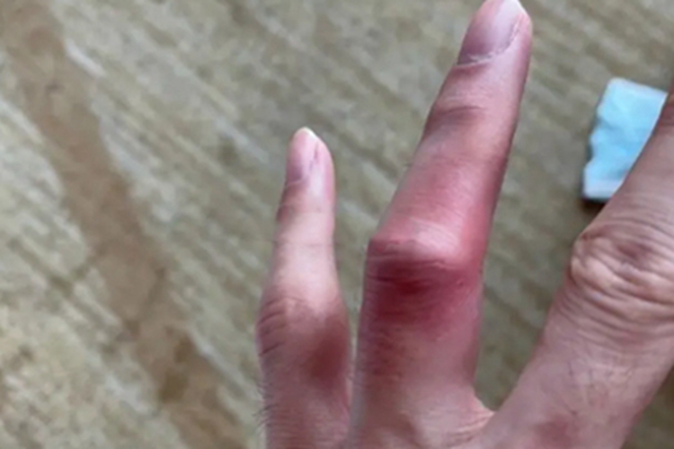 轻度扭伤手指症状图 轻度扭伤手指症状图