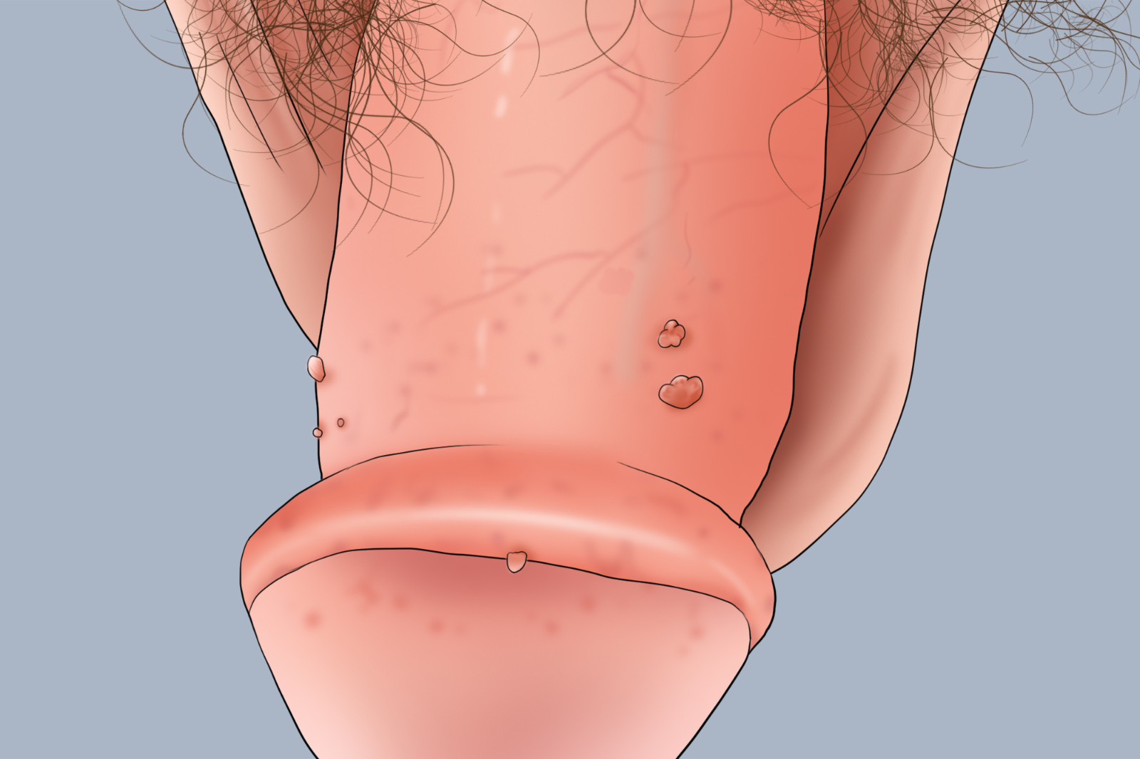 男性阴茎部的尖锐湿疣图
