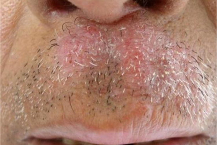 松皮癣鼻唇沟症状图 松皮癣鼻唇沟症状图