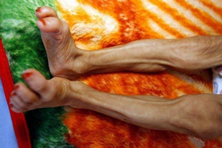 进行性脂肪营养不良小腿症状图