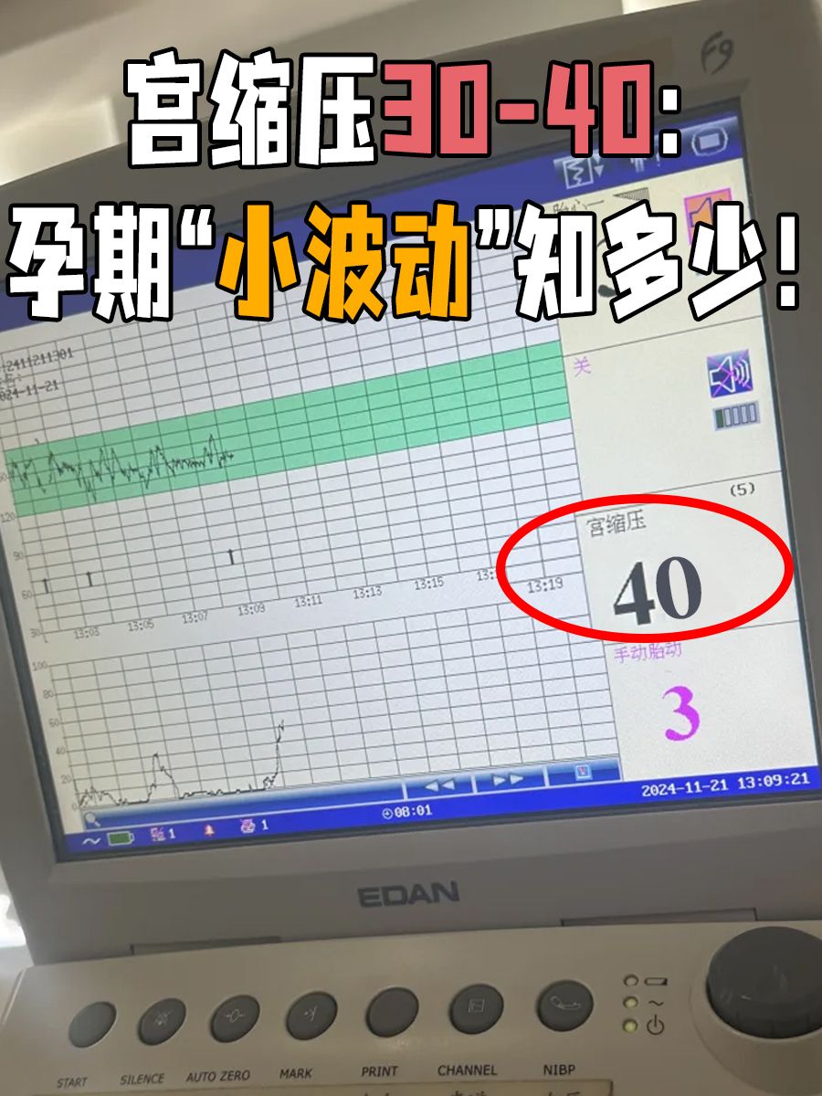 宫缩压30-40：孕期“小波动”知多少！