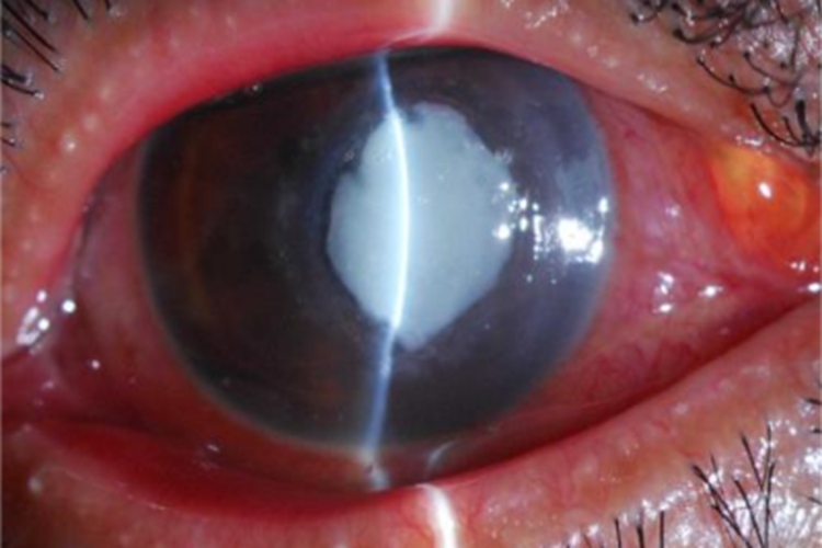 真菌性角膜溃疡眼球白斑图