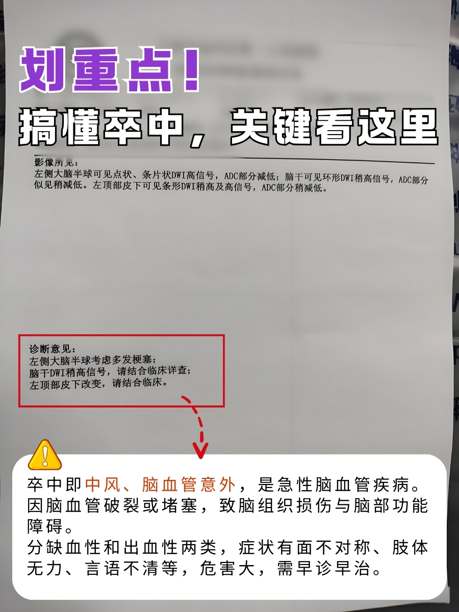 划重点！搞懂卒中，关键看这里