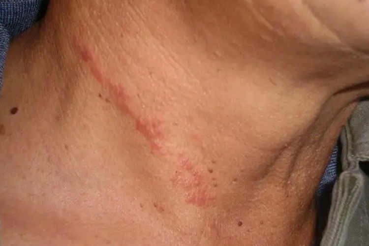 脖子接触性皮炎图 脖子接触性皮炎图