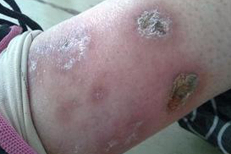 结节性血管炎胳膊结节图