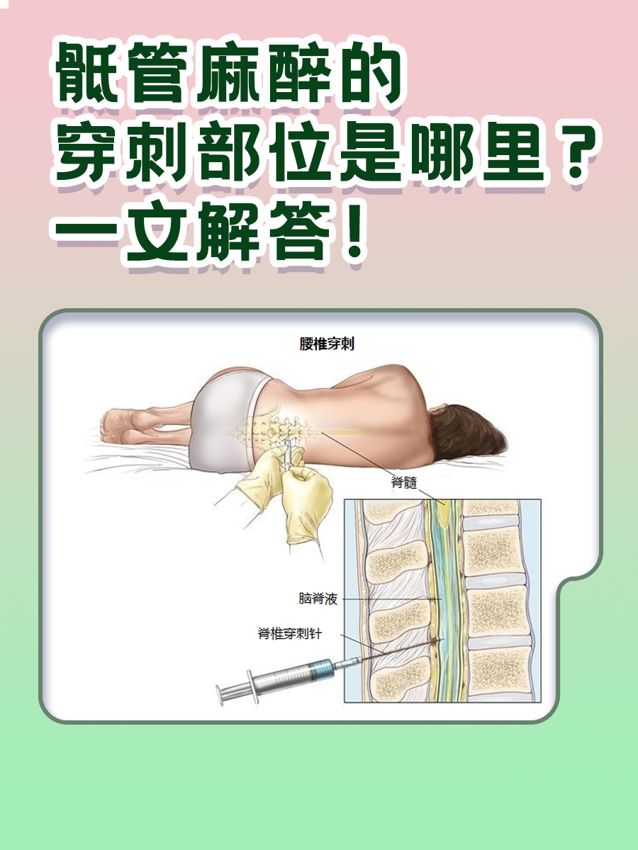 骶管麻醉的穿刺部位是哪里？一文解答！