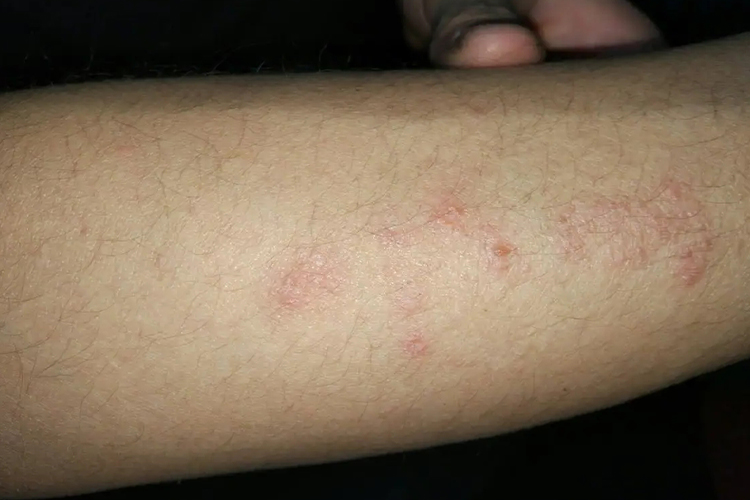 慢性湿疹手臂红点点图