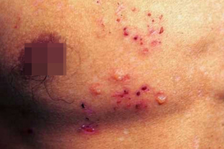 角层下脓疱性皮病脓包图 角层下脓疱性皮病脓包图