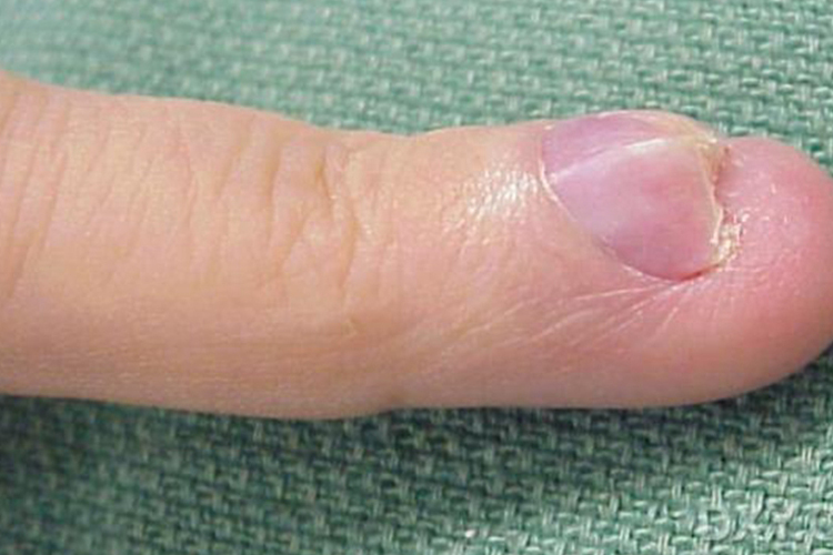 甲血管球瘤指甲凸出起小包图