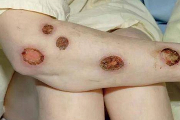 症状梅毒可累及胳膊,出现溃疡的症状,伴有红棕色痂皮,该病是由梅毒