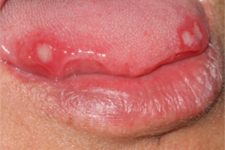 白塞病舌侧好多溃疡发白图 白塞病舌侧好多溃疡发白图