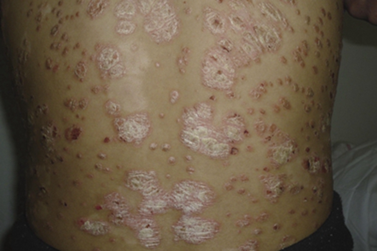 斑块型副银屑病症状图