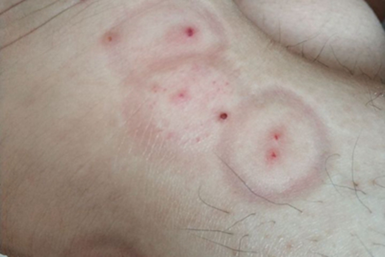 跳蚤叮咬脚踝有红点图