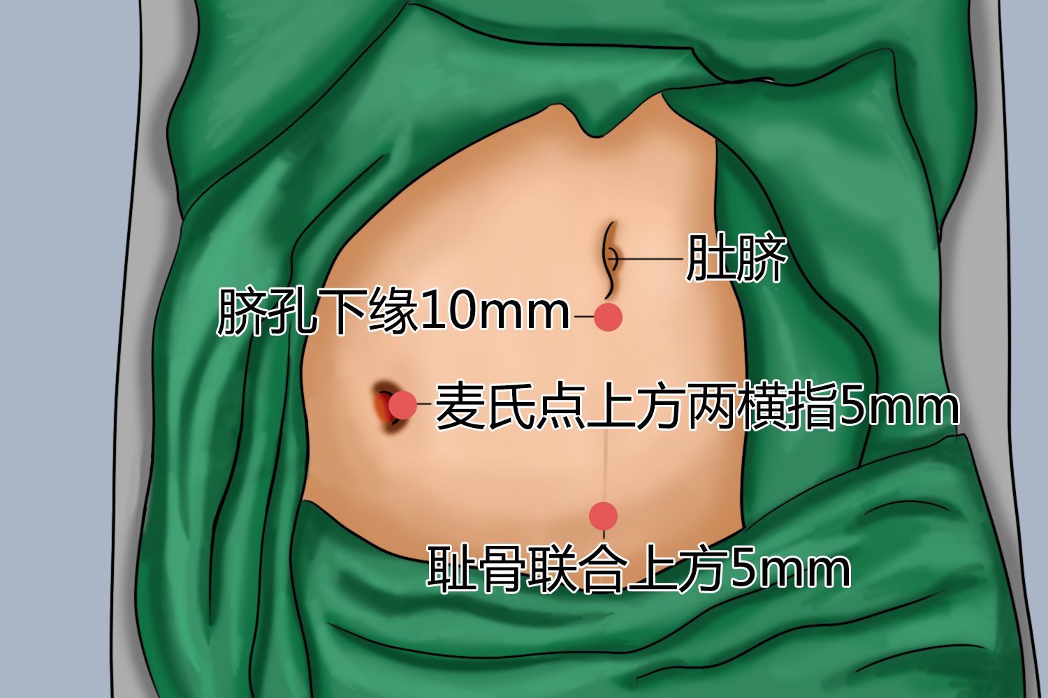 阑尾切口位置图片图片