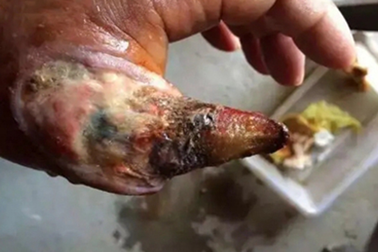 毒蛇咬伤手指坏死溃烂图
