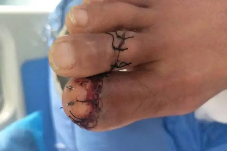 脚趾骨折打钢钉图 脚趾骨折打钢钉图