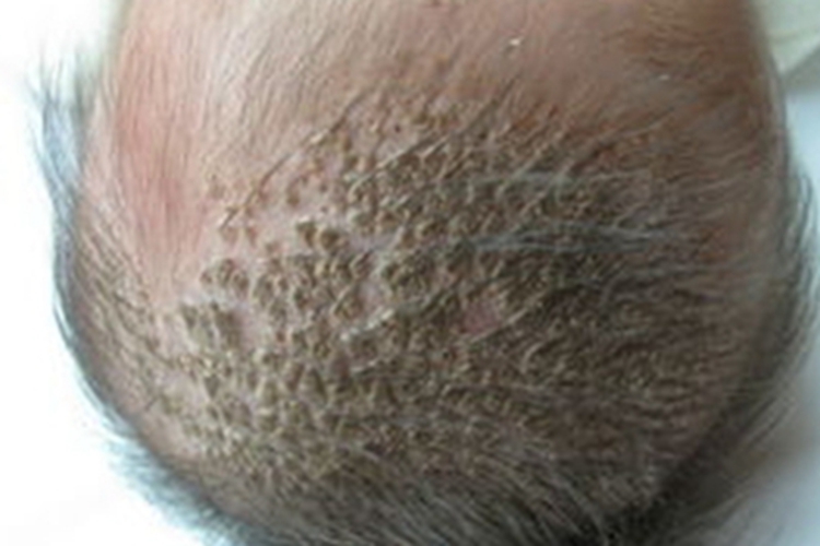 婴儿脂溢性皮炎头皮结痂图