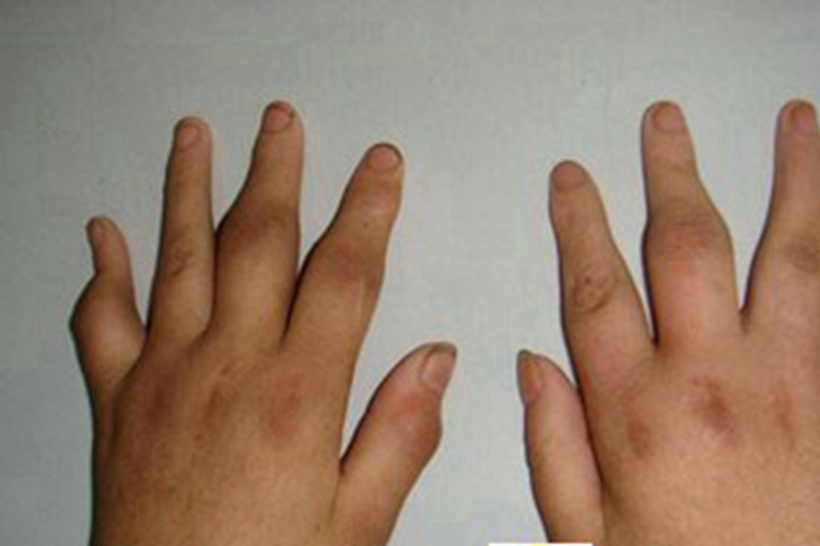 风湿性关节炎手指肿图