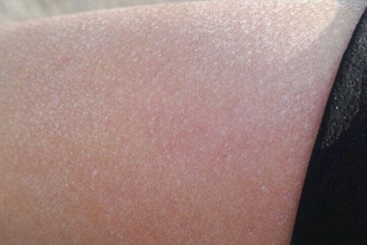 维生素A过多症腿部脱屑图 维生素A过多症腿部脱屑图